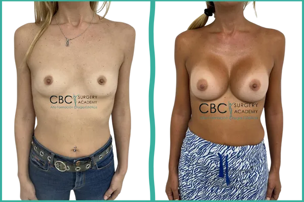 Resultado de aumento mamario por surco submamario con implantes redondos — caso clínico del equipo CBC