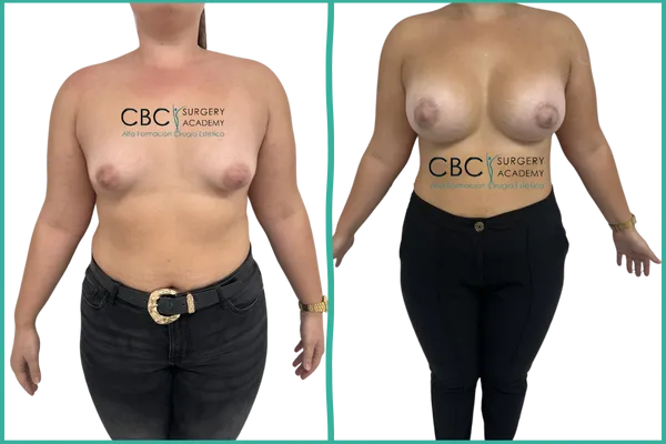 Resultado de mastopexia periareolar con implantes anatómicos — caso clínico CBC Academy