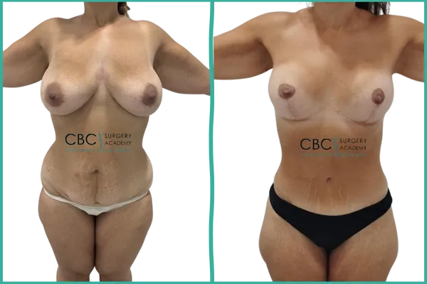 🩺De la planificación integral al resultado armónico: un caso de Mommy Makeover en CBC