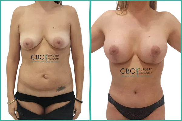 Resultado de mastopexia con implantes ergonómicos y abdominoplastia combinada — caso clínico CBC Academy