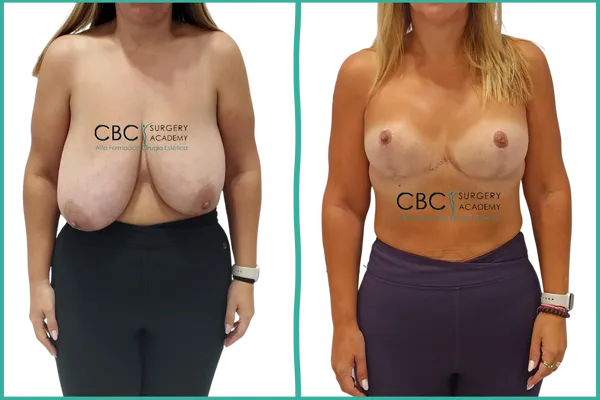 Resultado de reducción mamaria con implantes e injerto de areola — caso clínico CBC Academy.
