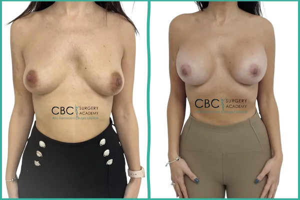 Resultado de mastopexia periareolar con implantes redondos — caso clínico CBC Academy