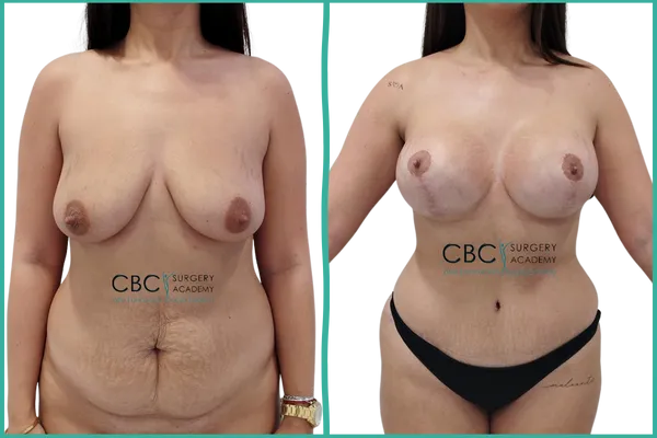 Resultado de mastopexia con implantes y abdominoplastia con lipoescultura 360 — caso clínico CBC Academy