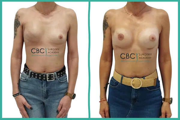 Reconstrucción mamaria tras mastectomía con implantes ergonómicos realizada en CBC.