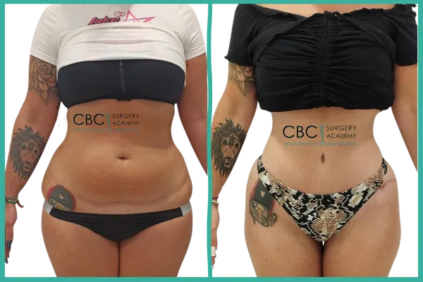 “Resultado de abdominoplastia con lipoescultura 360° — caso clínico CBC Academy.”
