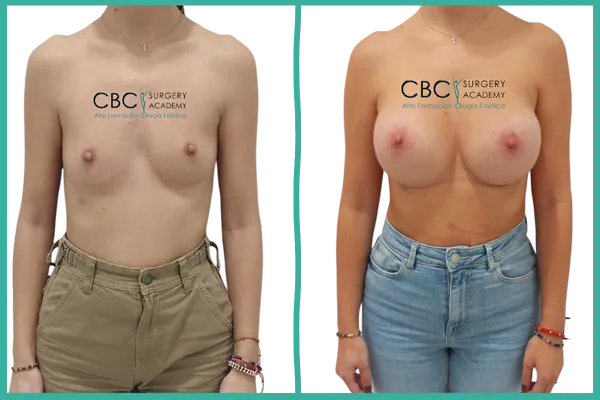 “Resultado estético de mastopexia periareolar compleja con implantes 812N 400cc en CBC.”
