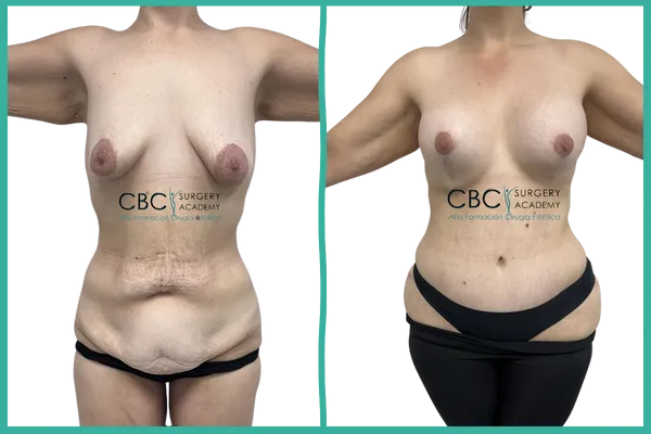 “Resultado corporal tras reducción mamaria 812N 500cc y abdominoplastia en CBC.”