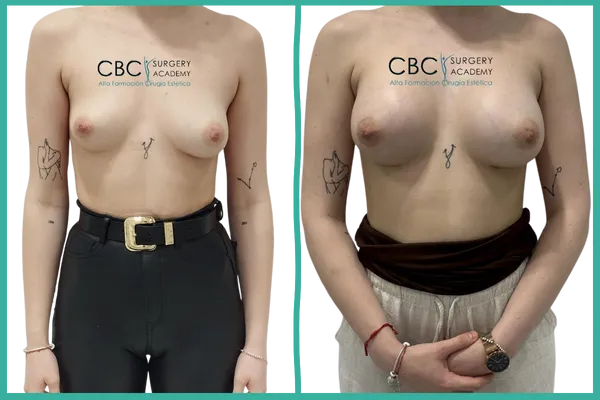 Composición visual del caso antes y después de aumento mamario simple. A la izquierda, imagen preoperatoria con asimetría visible; a la derecha, resultado final con mayor volumen, proyección y simetría. Diseño limpio, profesional y orientado a formación en cirugía corporal.