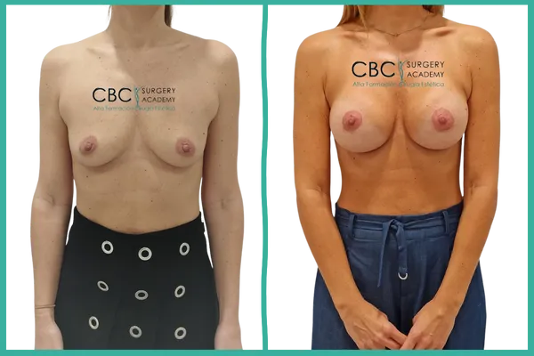 “Caso clínico de mastopexia periareolar con implantes ERSC 300Q.”