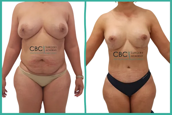 Resultado de contorno corporal tras abdominoplastia, reducción mamaria y liposucción de espalda, con pared abdominal firme y cicatrización controlada.