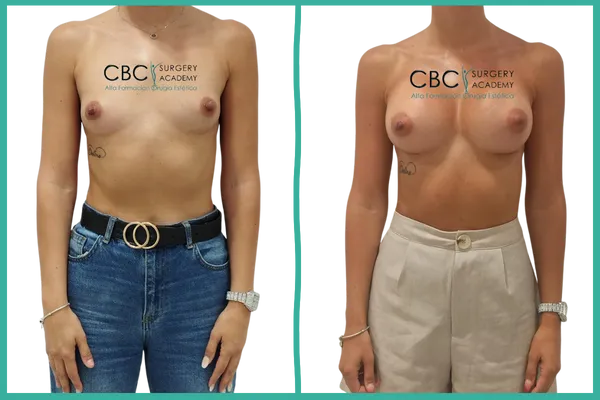 Comparativa Antes y Después del Aumento Mamario: A la izquierda, el volumen inicial de la paciente y, a la derecha, el resultado con implantes ergonómicos ERSC 410Q y la optimización del contorno tras la cirugía.