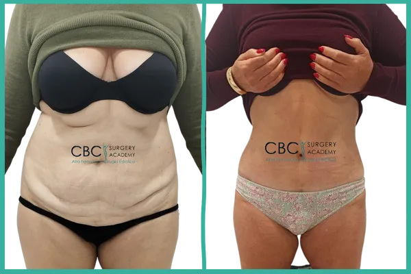 "Comparativa antes y después de una abdominoplastia con liposucción 360º realizada en CBC: transformación abdominal real tras la cirugía, con mejora del contorno corporal, flacidez y acumulación grasa."