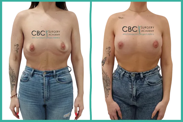 Antes y después de mastopexia periareolar con implantes, caso real utilizado en la formación de cirujanos de CBC Academy.