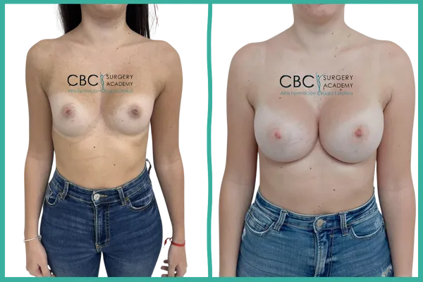 "Caso clínico de aumento mamario simple con implantes ergonómicos ERSC 350cc. Resultado final."
