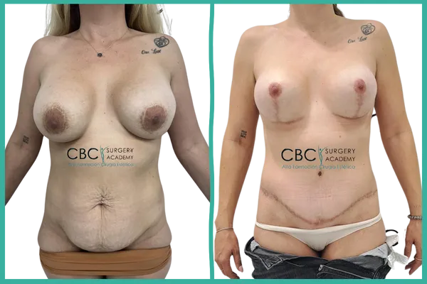 Caso combinado de cirugía corporal y mamaria con recambio protésico y remodelado abdominal