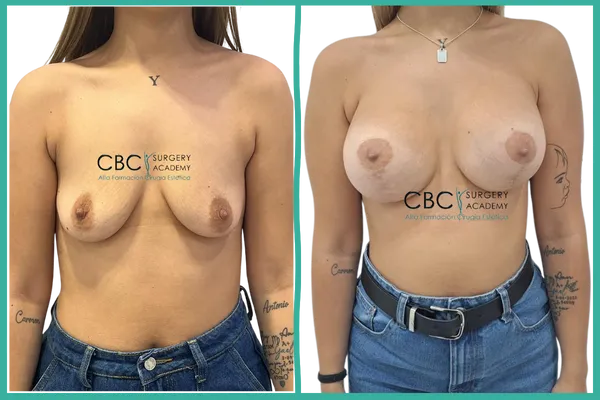 Caso de retoque mamario con transposición de grasa tras mastopexia areola–vertical con implantes 812N, orientado a formación quirúrgica en CBC Academy.