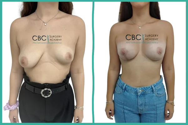 Caso de asimetría mamaria severa tratado con mastopexia vertical y periareolar.