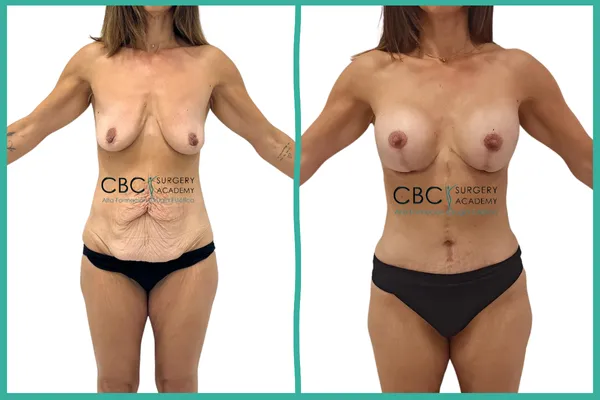 Composición visual impactante. Izquierda: Abdomen con doble faldón y gran flacidez vertical y horizontal. Derecha: Torso plano, cintura definida con la característica cicatriz vertical (Flor de Lis) ya madura.