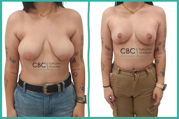 Resultado mastopexia mama tuberosa.