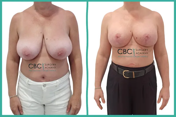 Comparativa Antes y Después: A la izquierda, la macromastia preoperatoria; a la derecha, el resultado tras la reducción con injerto libre e implantes retropectorales.