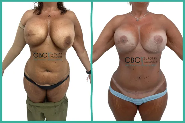 Comparativa de reconstrucción corporal integral en paciente post-cáncer de mama. Transformación de abdomen con diástasis y corrección de asimetría mamaria compleja mediante cirugía combinada y lipotransferencia.