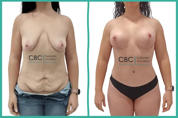 Transformación corporal postbariátrica. Comparativa de corrección de macromastia mediante injerto libre y reconstrucción de pared abdominal.