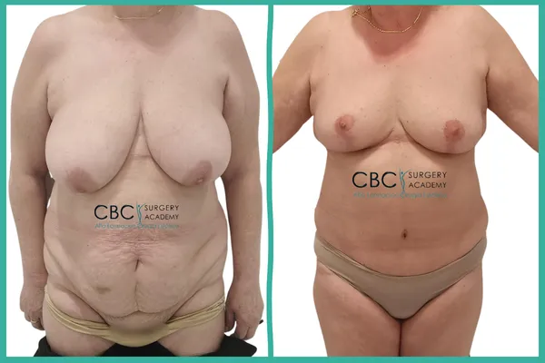 Gestión de caso complejo en paciente fumadora: Abdominoplastia y Reducción Mamaria con tratamiento exitoso de complicaciones de cicatrización.