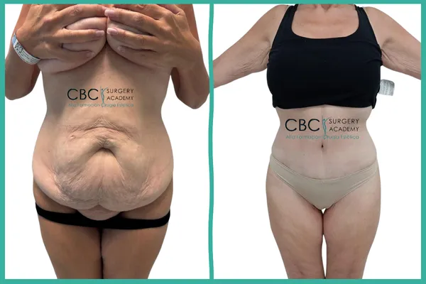 Reconstrucción abdominal extrema tras pérdida de 90kg. Comparativa de eliminación de faldón cutáneo y manejo de cicatrización en paciente fumadora.