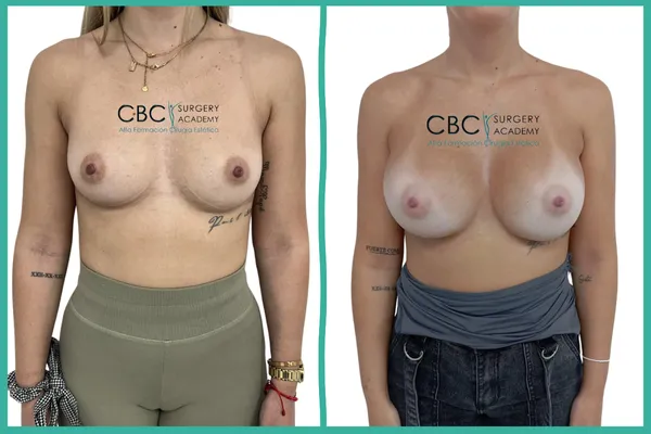 Evolución de aumento de pecho por surco submamario. Gestión de expectativas de volumen y seguimiento ecográfico por nódulo.