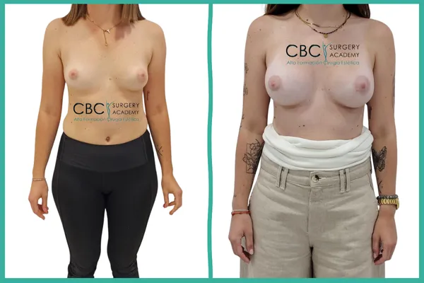 Corrección de asimetría y mama tuberosa mediante selección de implantes diferenciales y técnica periareolar.