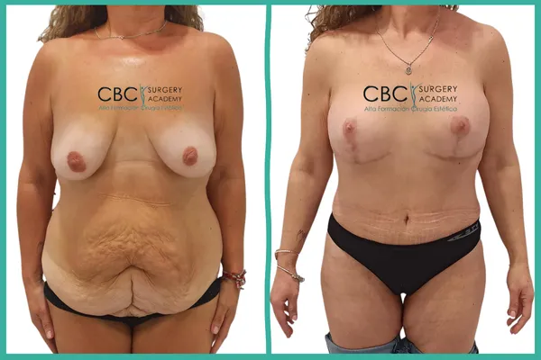 Transformación corporal integral. Corrección de secuelas de pérdida de peso mediante cirugía plástica y optimización nutricional.