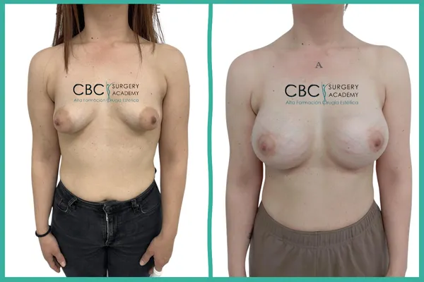 Transformación de mama tuberosa mediante técnicas avanzadas de mastopexia e implantes redondos.