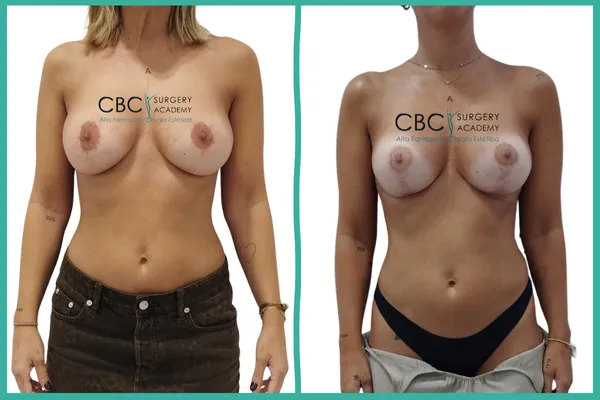 Cirugía de revisión mamaria compleja en CBC Academy. Corrección de forma y volumen mediante recambio de prótesis y pexia.