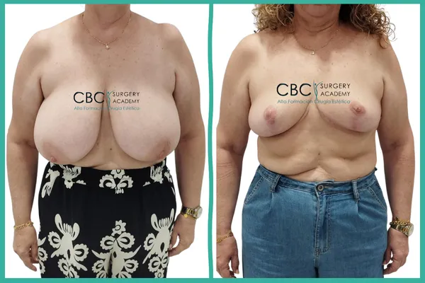 Transformación tras reducción mamaria funcional en CBC Academy. Resolución de macromastia y planificación de revisión de areola.