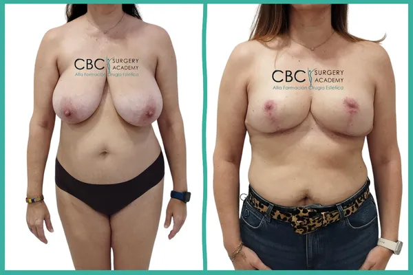 Transformación de macromastia gigante mediante reducción mamaria e injerto libre de areola. Caso clínico de alta complejidad en CBC Academy.
