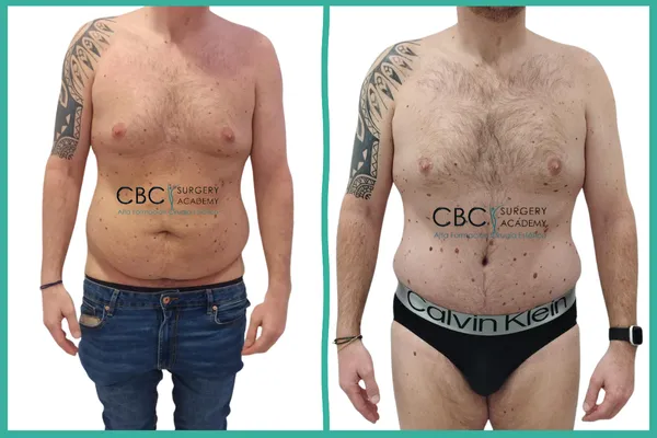 Contorno corporal masculino total. De la pérdida masiva de peso a la definición abdominal y pectoral en CBC.