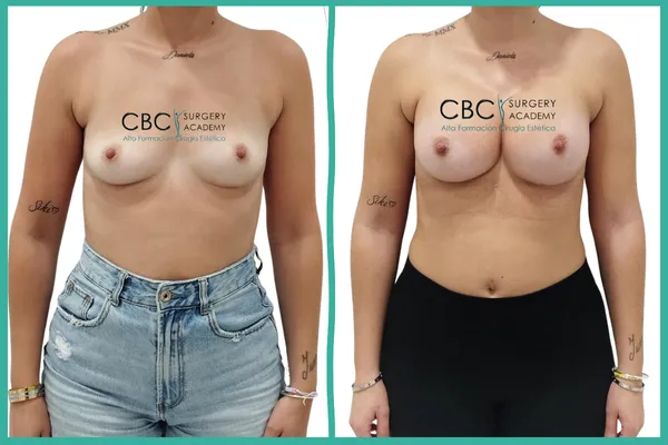 Aumento mamario simple en CBC Academy. Naturalidad y equilibrio tras la maternidad con implantes ergonómicos.