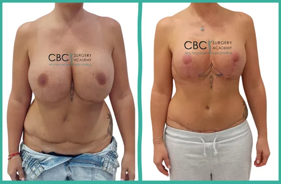 Cirugía cuaternaria de mama y abdomen. Rescate técnico mediante soporte interno y manejo vascular avanzado en CBC.