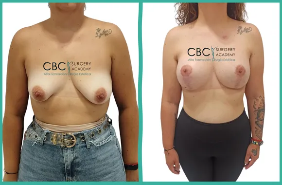 Antes y después de cirugía reparadora de mama con técnicas combinadas en CBC Academy.