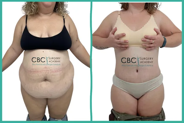 Cirugía reconstructiva post-bariátrica. Desafío técnico en cirugía combinada y gestión de cicatrización avanzada en CBC.