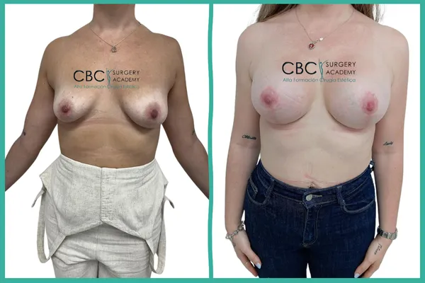 Antes y Después: Restauración del contorno mamario post-lactancia. Caso clínico de Mastopexia en T invertida con prótesis Nagor en CBC Academy.