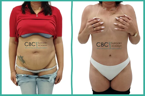  Transformación abdominal mediante cirugía y nutrición. Caso clínico de abdominoplastia con manejo de fibrosis y cicatrización en CBC Academy.