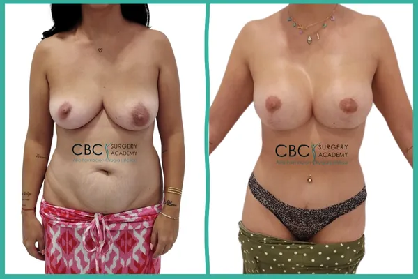 Cirugía reconstructiva post-embarazo. Desafío técnico y gestión de cicatrices en CBC Academy.