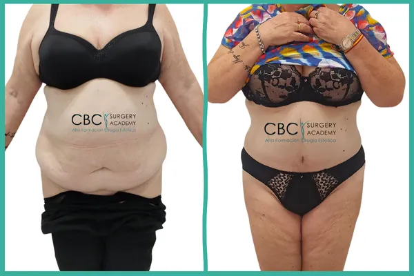 Antes y Después: Cirugía abdominal y límites del IMC. Realidad clínica vs. expectativas en CBC Academy.