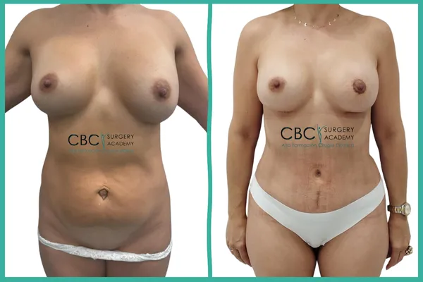 Antes y Después: Cirugía de refinamiento y Mommy Makeover integral. Gestión de asimetrías en CBC Academy.