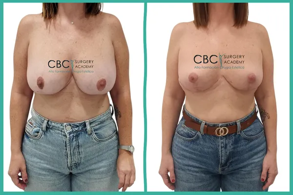 Antes y Después: Cirugía de revisión mamaria. Explantación y manejo de isquemia areolar en CBC Academy.