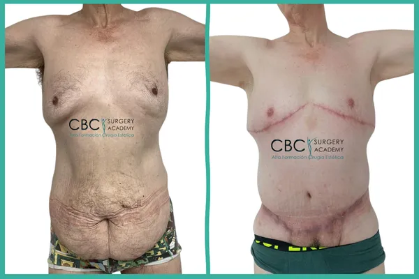 Antes y Después: Cirugía reconstructiva masiva. Uso de Terapia de Presión Negativa y PRP en CBC Academy.