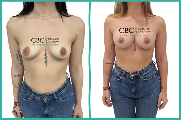 ntes y Después: Mastopexia Periareolar y aumento mamario. Técnica de donut y manejo de cicatrices en CBC Academy.
