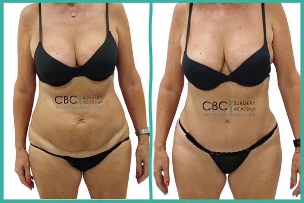 Antes y Después: Cirugía de contorno corporal en la madurez. Manejo de complicaciones vasculares en CBC Academy.
