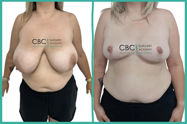Antes y Después: Reducción mamaria sin implantes. Manejo del Síndrome de Mondor y salud vertebral en CBC Academy.